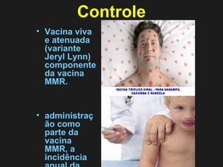 Controle 
• Vacina viva 
e atenuada 
(variante 
Jeryl Lynn) 
componente 
da vacina 
MMR. 
• administraç 
ão como 
parte da 
vacina 
MMR, a 
incidência 
anual da 
 