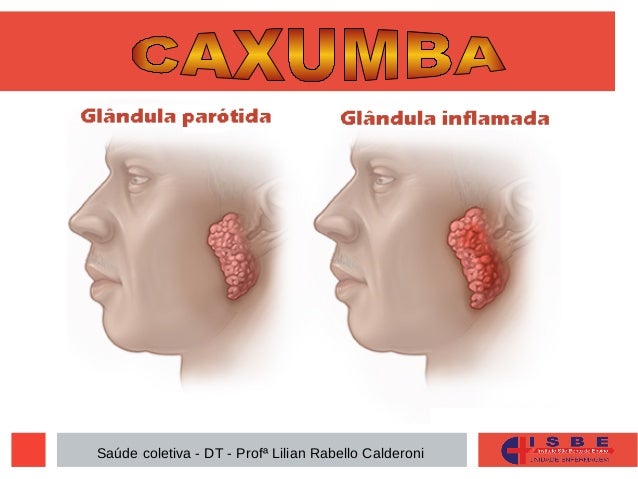 sade-coletiva-caxumba-parotidite-infecciosa-1-638.jpg?cb=1472234745