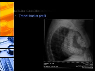 • Tranzit baritat profil
 
