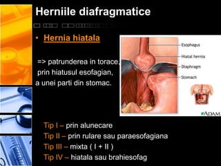 Herniile diafragmatice

• Hernia hiatala

=> patrunderea in torace,
prin hiatusul esofagian,
a unei parti din stomac.




  Tip I – prin alunecare
  Tip II – prin rulare sau paraesofagiana
  Tip III – mixta ( I + II )
  Tip IV – hiatala sau brahiesofag
 