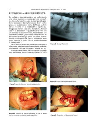 Revista Mexicana de Cirugía Bucal y Maxilofacial 2010;6 (2): 41-4644
www.medigraphic.org.mx
Este documento es elaborado por Medigraphic
Figura 5. Resección en bloque de la lesión.
Figura 3. Radiografía inicial.
Figura 4. Fotografía histológica del tumor.
Figura 1. Aparato distractor alveolar subperióstico.
Figura 2. Vástago de aparato distractor, el cual se revisa
que no contacte con los dientes antagonistas.
DISTRACCIÓN ALVEOLAR HORIZONTAL
Se realiza en algunos casos en los cuales existe
una altura alveolar adecuada, pero no una sufi-
ciente anchura del reborde alveolar para la pos-
terior colocación de implantes; es decir, en los
procesos alveolares en forma de filo de cuchillo
se han resuelto con la colocación de injertos au-
tólogos de mentón o de rama mandibular. Pero el
uso de la distracción se puede llevar a cabo con
un distractor alveolar intraóseo, haciendo sólo una
osteotomía vertical y colocando este distractor de
tal forma que el vástago quede horizontal, normal-
mente hacia vestibular, y sin la colocación de la
placa para que se pueda colocar posteriormente el
o los implantes.6
Se ha descrito el uso de la distracción osteogénica
alveolar en injertos colocados en la región maxilofa-
cial, como el caso que se presenta en este artículo.
Los injertos de cresta iliaca presentan un grado
muy variable de resorción vertical (de ahí la deci-
 