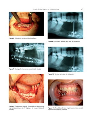 Fernando González Magaña y col. Distracción alveolar 45
www.medigraphic.org.mx
Figura 6. Colocación de injerto de cresta iliaca.
Figura 7. Radiografía 3 semanas posterior a la cirugía.
Figura 8. Osteotomía alveolar (obsérvese lo pequeño del
fragmento a distraer, de ahí el peligro de fracturarlo o avul-
sionarlo).
Figura 9. Radiografía al inicio de la fase de distracción.
Figura 10. Término de la fase de distracción.
Figura 11. Rehabilitación con implantes dentales para la
posterior rehabilitación protésica.
 