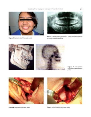 Zeyda María Oliman Hoyos y cols. Osteoma central en cóndilo mandibular 63
www.medigraphic.org.mx
Figura 5. Lecho quirúrgico masa ósea.
Figura 1. Paciente de 15 años de edad.
Figura 2. Radiografía panorámica que muestra lesión mixta
en región condilar derecha.
Figura 4. Extirpación de masa ósea.
Figura 3. Tomografía
tridimensional y centello-
grafía.
 