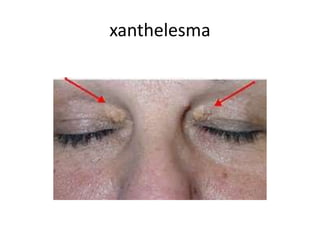 xanthelesma
 