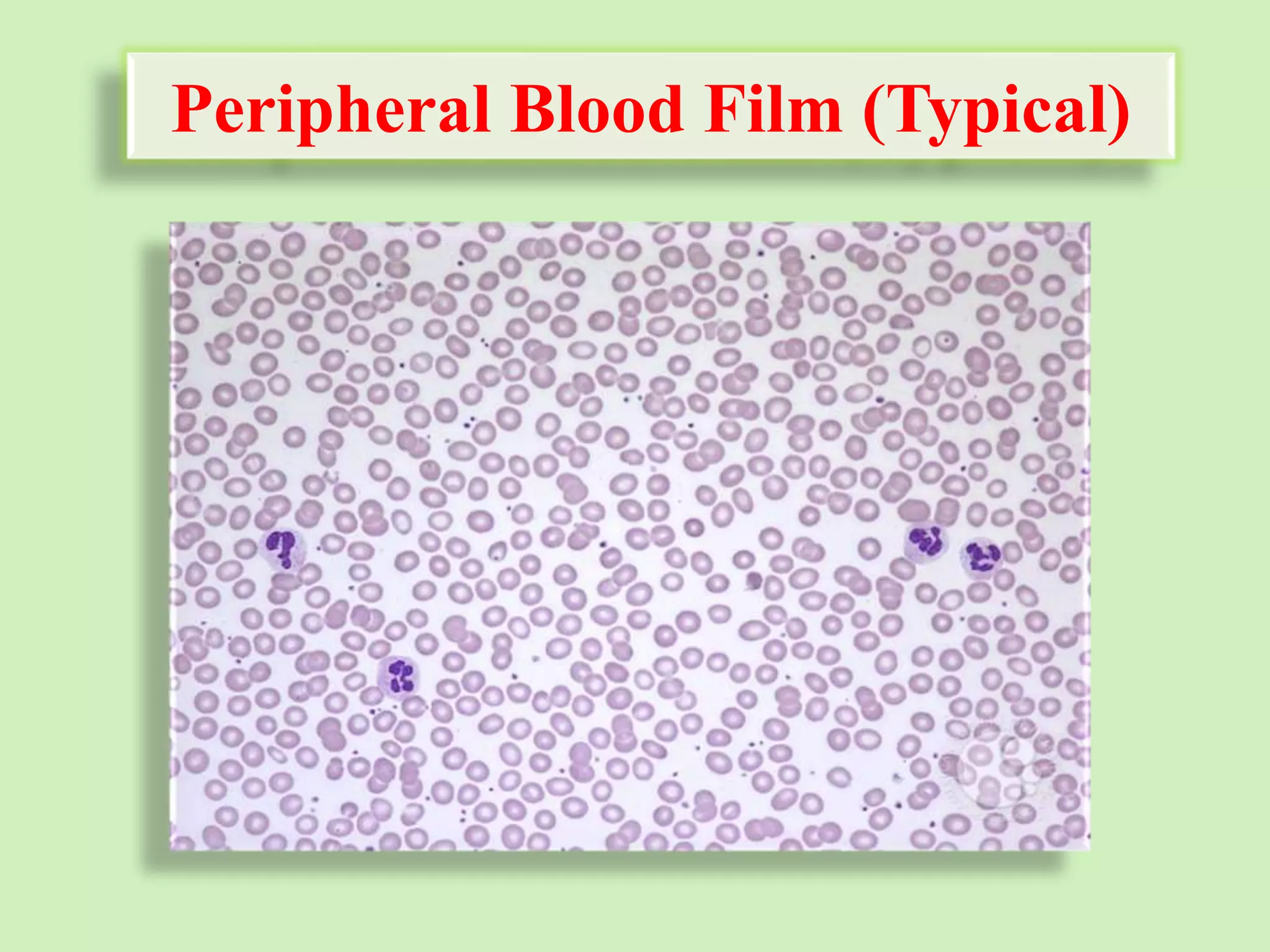 Peripheral Blood Film (Typical)
 