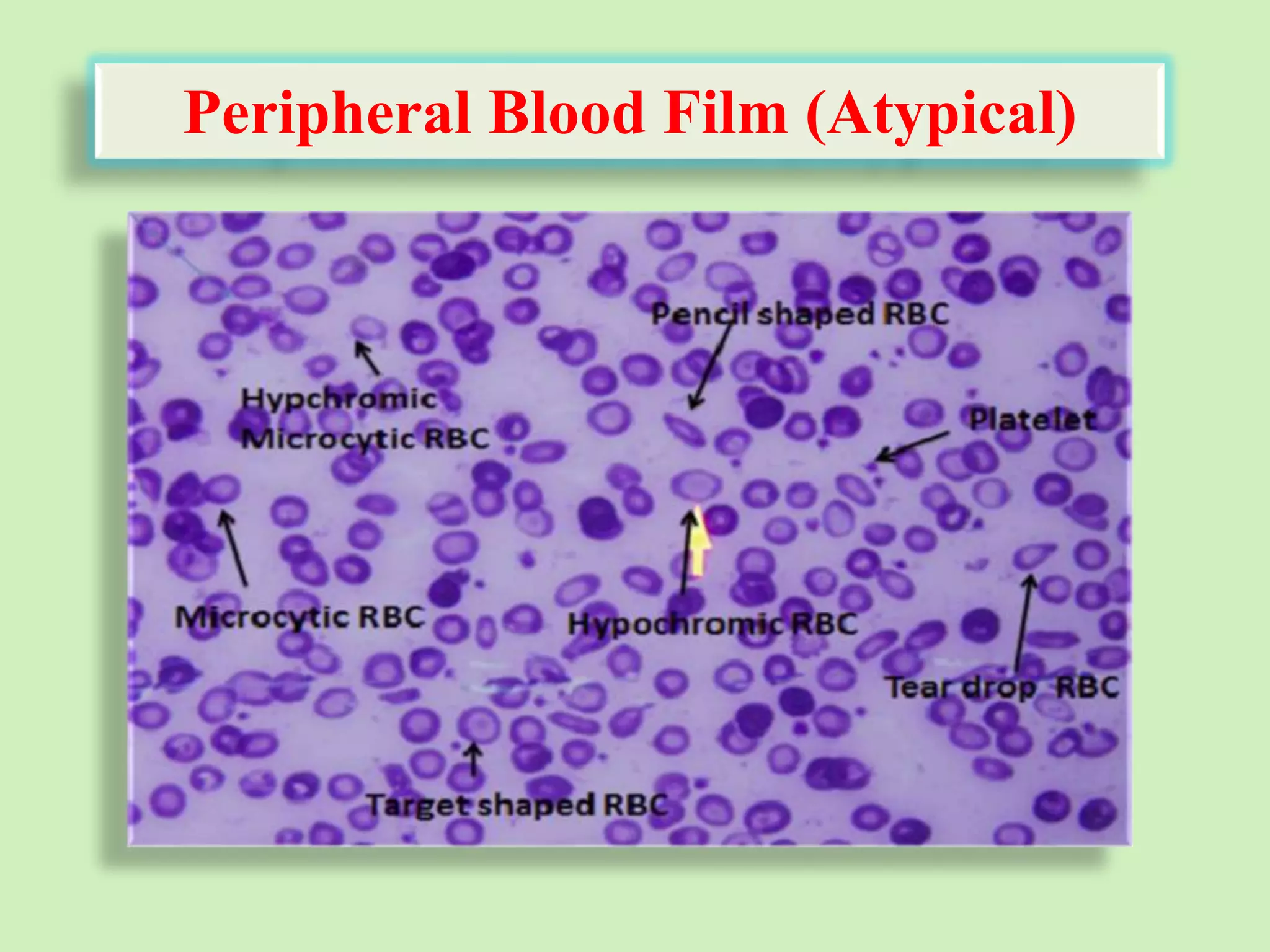 Peripheral Blood Film (Atypical)
 