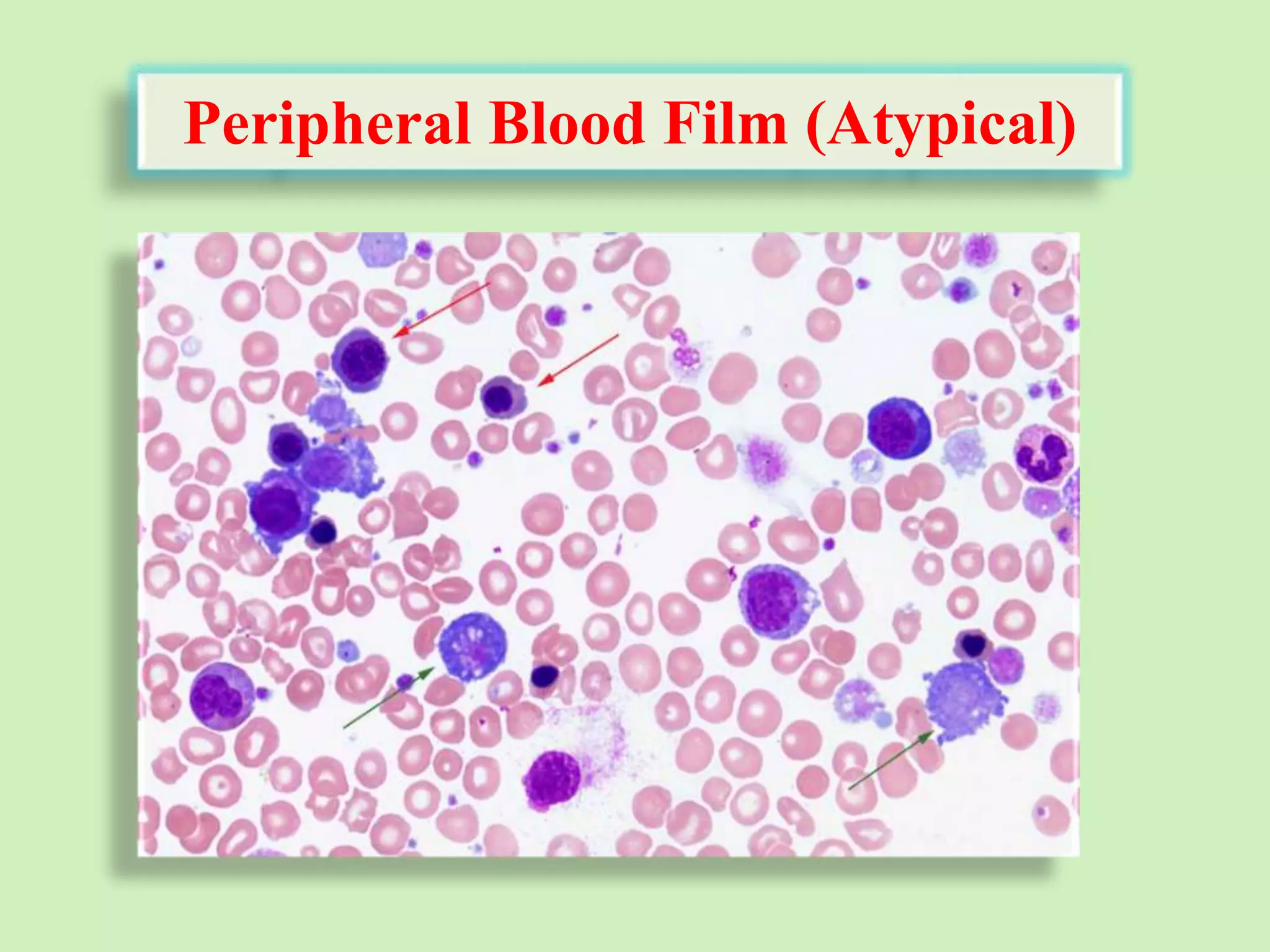 Peripheral Blood Film (Atypical)
 