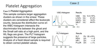 Platelet Aggregation
Case 2: Platelet Aggregation
This sample contains larger aggregation
clusters as shown in the smear. These
clusters are considered affect the leukocyte
counts, because the distribution curve on
the WBC histogram intersects the
discriminator line between the ghost and
the Small cell ratio at a high point, and the
WL flags are given. The PLT histogram
suggests the presence of large particles.
Analysis of a fresh blood sample is required
to obtain correct platelet values.
 