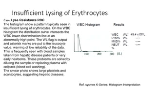 Insufficient Lysing of Erythrocytes
Case: Lyse Resistance RBC
The histogram show a pattern typically seen in
insufficient lysing of erythrocytes. On the WBC
histogram the distribution curve intersects the
WBC lower discrimination line at an
abnormally high point. The WL flag is output
and asterisk marks are put to the leucocyte
value, warning of low reliability of the data.
This is frequently seen with blood samples
taken from hepatic disease patients or very
early newborns. These problems are solvedby
diluting the sample or replacing plasma with
cellpack (blood cell washing).
The smear photo shows large platelets and
acantocytes, suggesting hepatic diseases.
Ref. sysmex K-Series: Histogram Interpretation
 