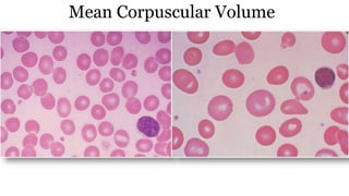 Mean Corpuscular Volume
MCV is average volume of the red blood cell
80-100 fl
>100 fl
<80 fl
The blood analyser >> microscopic observation
Microcytic + macrocytic cells =normal MCV
MCV = (hematocrit/red cell count) × 100
 