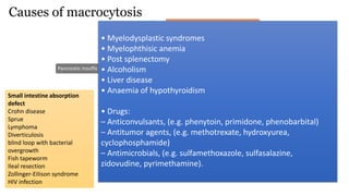 Poor vitamin B12 intake (vegans)
Pernicious Anemia
Gastric Surgery
Pancreatic insufficiency
Small intestine absorption
defect
Crohn disease
Sprue
Lymphoma
Diverticulosis
blind loop with bacterial
overgrowth
Fish tapeworm
Ileal resection
Zollinger-EIIison syndrome
HIV infection
Causes of macrocytosis
• Myelodysplastic syndromes
• Myelophthisic anemia
• Post splenectomy
• Alcoholism
• Liver disease
• Anaemia of hypothyroidism
• Drugs:
– Anticonvulsants, (e.g. phenytoin, primidone, phenobarbital)
– Antitumor agents, (e.g. methotrexate, hydroxyurea,
cyclophosphamide)
– Antimicrobials, (e.g. sulfamethoxazole, sulfasalazine,
zidovudine, pyrimethamine).
 