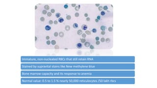 Immature, non-nucleated RBCs that still retain RNA
Stained by supravital stains like New methylene blue
Bone marrow capacity and its response to anemia
Normal value: 0.5 to 1.5 % nearly 50,000 reticulocytes /50 lakh rbcs
 