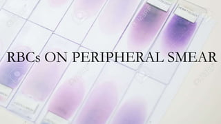 RBCs ON PERIPHERAL SMEAR
 