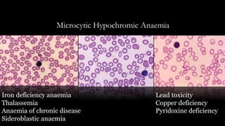 Microcytic Hypochromic Anaemia
Iron deficiency anaemia
Thalassemia
Anaemia of chronic disease
Sideroblastic anaemia
Lead toxicity
Copper deficiency
Pyridoxine deficiency
 