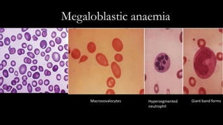 Megaloblastic anaemia
Giant band formsMacrovovalocytes Hypersegmented
neutrophil
 