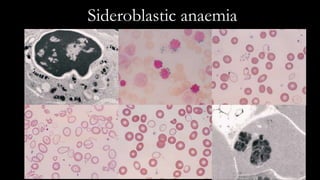 Sideroblastic anaemia
 