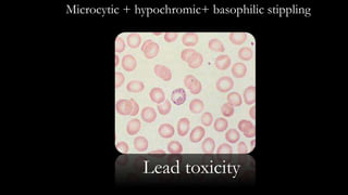Microcytic + hypochromic+ basophilic stippling
Lead toxicity
 