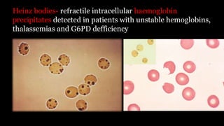 Heinz bodies- refractile intracellular haemoglobin
precipitates detected in patients with unstable hemoglobins,
thalassemias and G6PD defficiency
 