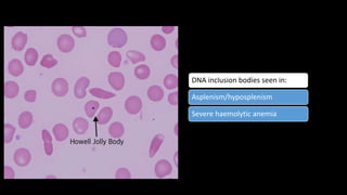 DNA inclusion bodies seen in:
Asplenism/hyposplenism
Severe haemolytic anemia
 