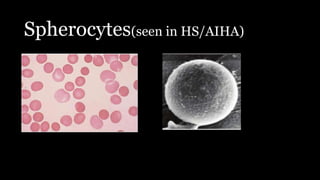 Spherocytes(seen in HS/AIHA)
 