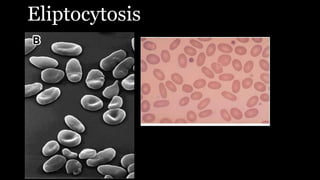 Eliptocytosis
 