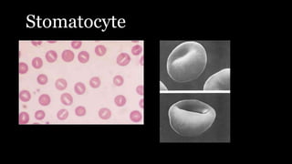 Stomatocyte
 
