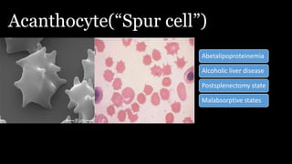 Acanthocyte(“Spur cell”)
Abetalipoproteinemia
Alcoholic liver disease
Postsplenectomy state
Malabsorptive states
 