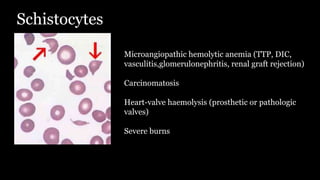 Schistocytes
Microangiopathic hemolytic anemia (TTP, DIC,
vasculitis,glomerulonephritis, renal graft rejection)
Carcinomatosis
Heart-valve haemolysis (prosthetic or pathologic
valves)
Severe burns
 