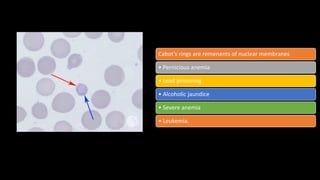 Cabot’s rings are remenents of nuclear membranes
• Pernicious anemia
• Lead poisoning
• Alcoholic jaundice
• Severe anemia
• Leukemia.
 