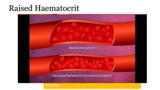 Raised Haematocrit
INCREASED RED BLOOD CELLS OR DECREASED PLASMA
Dehydration (such as from severe diarrhea)
Dengue shock syndrome
Kidney disease with high erythropoietin production
Cyanotic congenital heart disease
COPD
High altitude
Polycythemia vera
Smoking
 