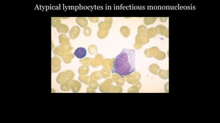 Atypical lymphocytes in infectious mononucleosis
 