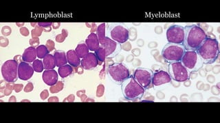 Lymphoblast Myeloblast
 