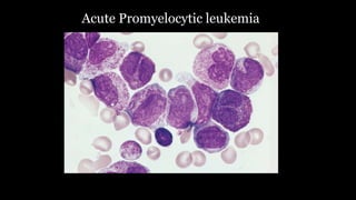 Acute Promyelocytic leukemia
 