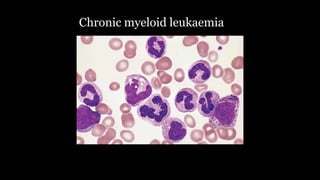 Chronic myeloid leukaemia
 