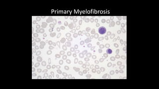 Primary Myelofibrosis
 