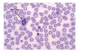 Selective marrow suppression of platelet production due
to—
– Drugs
– Infections
– Ethanol.
Ineffective thrombopoiesis due to—
– Folate or B12 deficiency.
Hereditary disorders
– May-Hegglin anomaly
– Wiskott-Aldrich syndrome
Dhole bodies
 