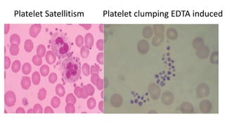 Platelet Satellitism Platelet clumping EDTA induced
 