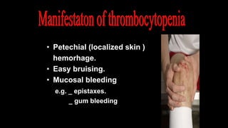 • Petechial (localized skin )
hemorhage.
• Easy bruising.
• Mucosal bleeding
e.g. _ epistaxes.
_ gum bleeding
 