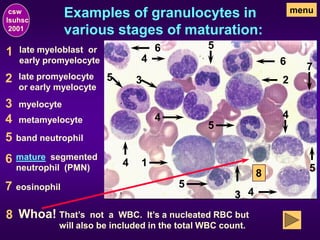 Examples of granulocytes in
various stages of maturation:
1 late myeloblast or
early promyelocyte
1
2 late promyelocyte
or early myelocyte
2
3 myelocyte
3
3
4 metamyelocyte
4
4
4
4
4
5 band neutrophil
5
5
5
5
5
6 mature segmented
neutrophil (PMN)
6
6
7 eosinophil
7
8 Whoa!
8
That’s not a WBC. It’s a nucleated RBC but
will also be included in the total WBC count.
menu
csw
lsuhsc
2001
 