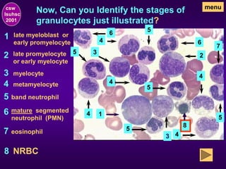 Now, Can you Identify the stages of
granulocytes just illustrated?
1
1
late myeloblast or
early promyelocyte
2 2
late promyelocyte
or early myelocyte
3
3
3
myelocyte
4
4
4
4
4
4
metamyelocyte
5
5
5
5
5
5
band neutrophil
6
6
6
mature segmented
neutrophil (PMN)
7
7
eosinophil
8
menu
NRBC
csw
lsuhsc
2001
8
 