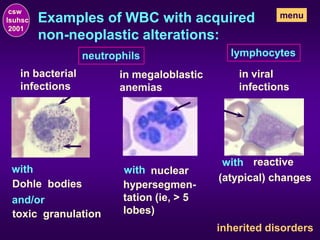 Examples of WBC with acquired
non-neoplastic alterations:
neutrophils
in bacterial
infections
with
Dohle bodies
and/or
toxic granulation
in megaloblastic
anemias
with nuclear
hypersegmen-
tation (ie, > 5
lobes)
lymphocytes
in viral
infections
with reactive
(atypical) changes
inherited disorders
csw
lsuhsc
2001
menu
 