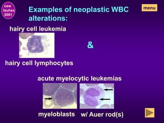 Examples of neoplastic WBC
alterations:
hairy cell lymphocytes
hairy cell leukemia
&
myeloblasts w/ Auer rod(s)
acute myelocytic leukemias
csw
lsuhsc
2001
menu
 