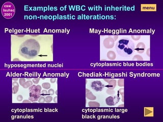 Examples of WBC with inherited
non-neoplastic alterations:
Pelger-Huet Anomaly
hyposegmented nuclei
May-Hegglin Anomaly
cytoplasmic blue bodies
Alder-Reilly Anomaly
cytoplasmic black
granules
csw
lsuhsc
2001
Chediak-Higashi Syndrome
cytoplasmic large
black granules
menu
 