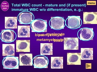 Total WBC count - mature and (if present)
immature WBC w/o differentiation, e..g.:
csw
lsuhsc
2001
menu
blast
promyelocyte
myelocyte
metamyelocyte
band
 