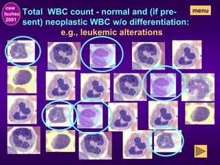 Total WBC count - normal and (if pre-
sent) neoplastic WBC w/o differentiation:
csw
lsuhsc
2001
menu
e.g., leukemic alterations
 