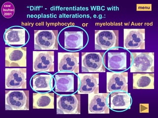 “Diff” - differentiates WBC with
neoplastic alterations, e.g.:
csw
lsuhsc
2001
menu
or
hairy cell lymphocyte myeloblast w/ Auer rod
 