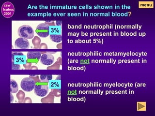 Are the immature cells shown in the
example ever seen in normal blood?
csw
lsuhsc
2001
menu
3%
2%
3%
band neutrophil (normally
may be present in blood up
to about 5%)
neutrophilic metamyelocyte
(are not normally present in
blood)
neutrophilic myelocyte (are
not normally present in
blood)
 
