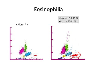 CBC, Principle of Cell Counter, Interpretation of Histogram ...