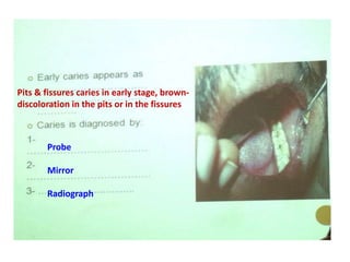 Pits & fissures caries in early stage, brown-
discoloration in the pits or in the fissures
Probe
Mirror
Radiograph
 