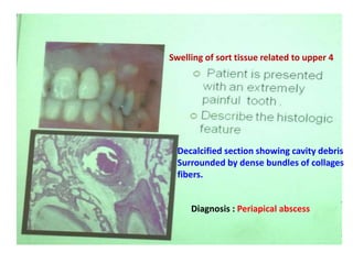 Swelling of sort tissue related to upper 4
Decalcified section showing cavity debris
Surrounded by dense bundles of collages
fibers.
Diagnosis : Periapical abscess
 